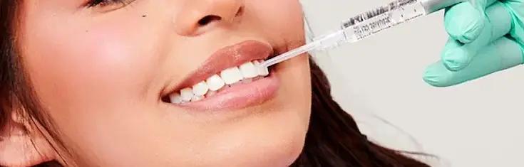 Sbiancamento Denti